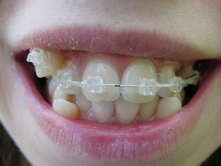 зубы после установки дуги