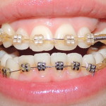 После 6-7 месяцев ношения брекетов (фото зубов до и после)