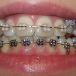 Изменение положения зуба через две недели после приклеивания брекета