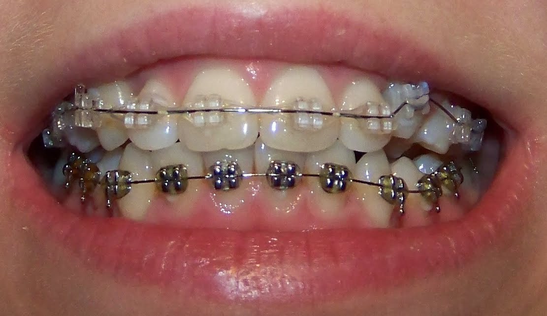 Изменение положения зуба через две недели после приклеивания брекета .
